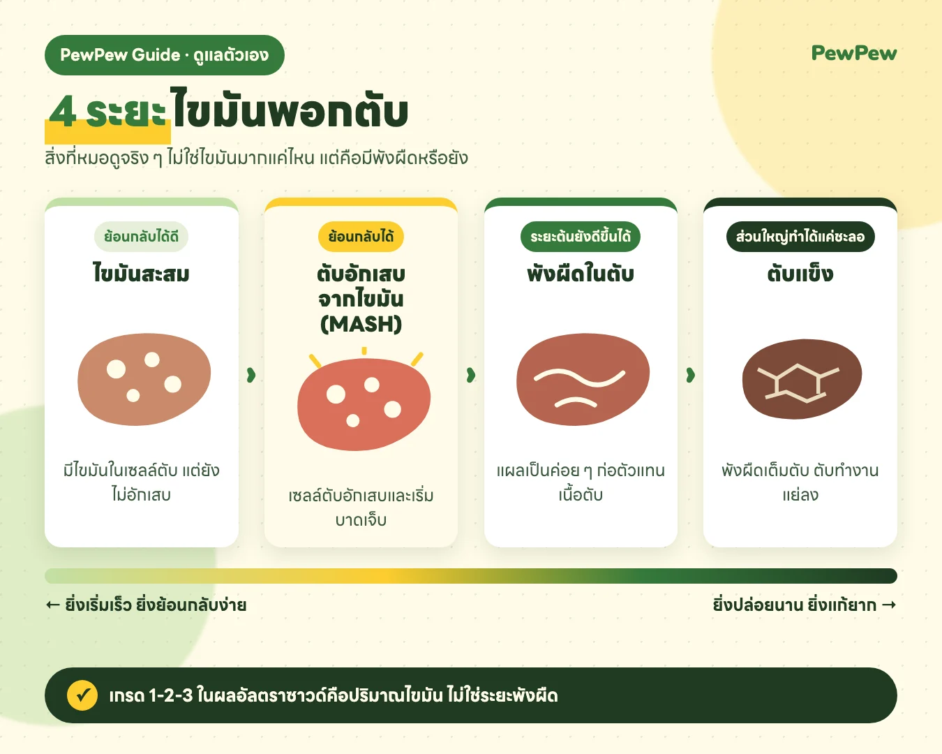 อินโฟกราฟิก 4 ระยะไขมันพอกตับ ไขมันสะสม ตับอักเสบจากไขมัน พังผืดในตับ และตับแข็ง